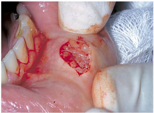 唇腺活检手术步骤图图片