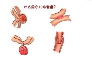 5,肠扭转,肠梗阻:可在肠旋转不良,肠粘连,小肠重复畸形等基础上发病